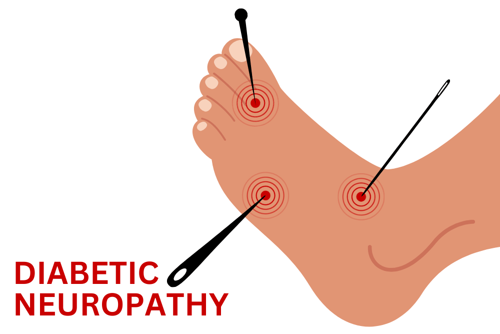 Diabetic-Neuropathy