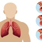 Pulmonary-Embolism