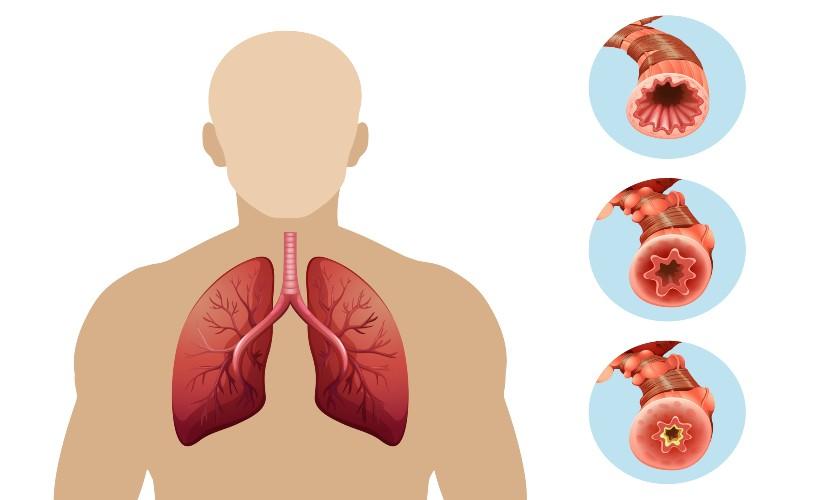 Pulmonary-Embolism