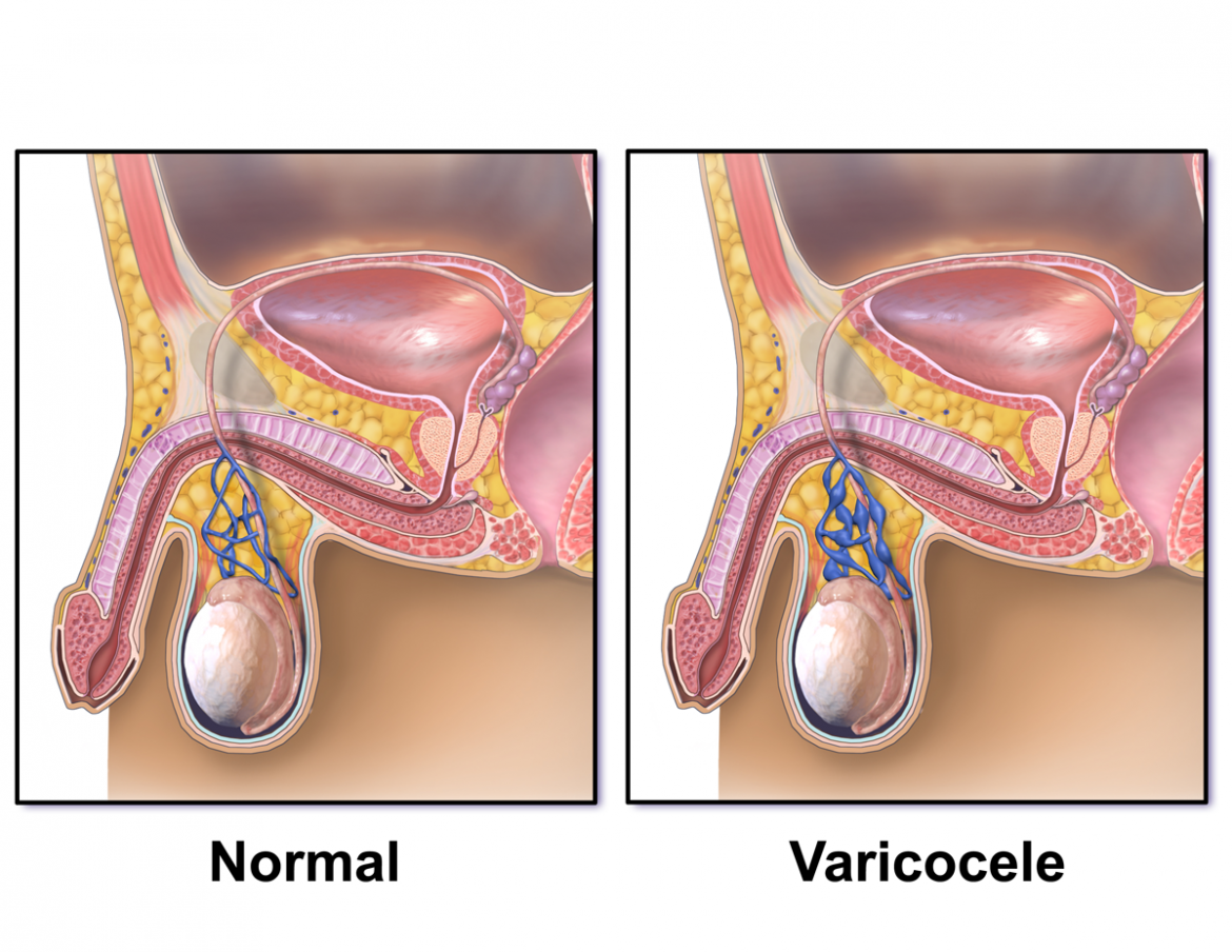 Varicocele  Tan Urology