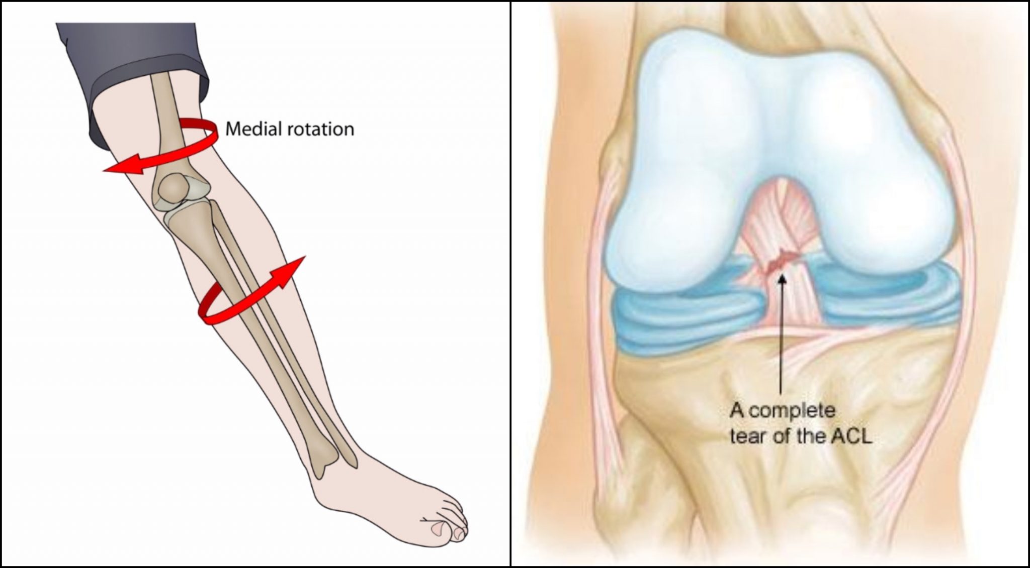 ANTERIOR CRUCIATE LIGAMENT INJURY Chandigarh Ayurved Panchakarma Centre posterior-cruciate-ligament-pcl-injury-symptoms-treatment