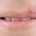 cold-sores