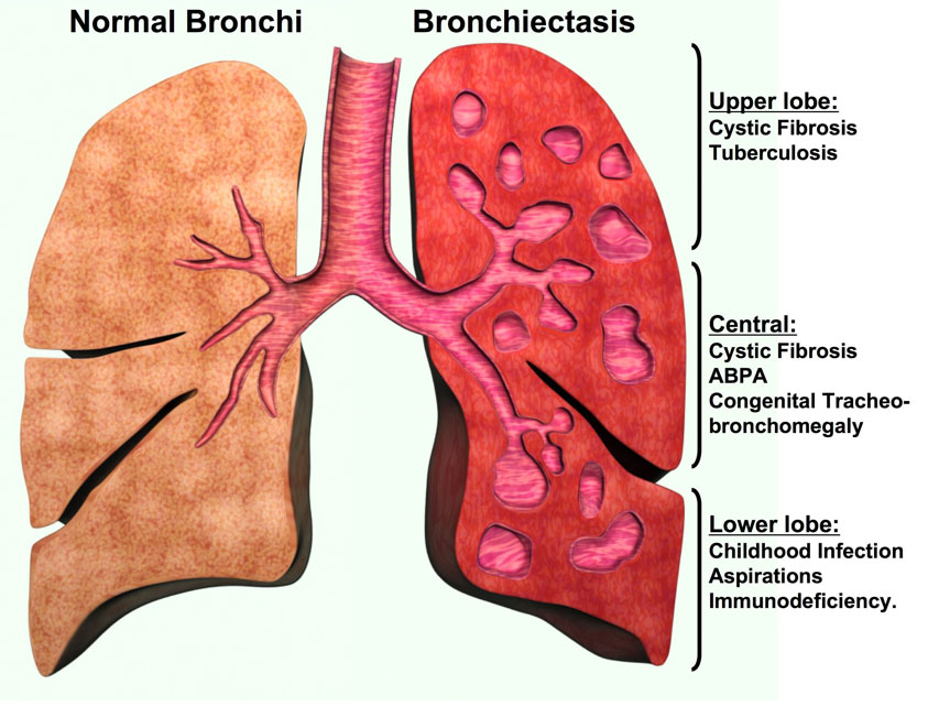 bronchiectasis