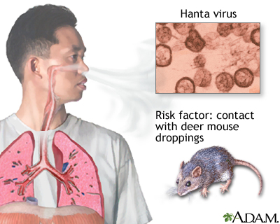 hantavirus