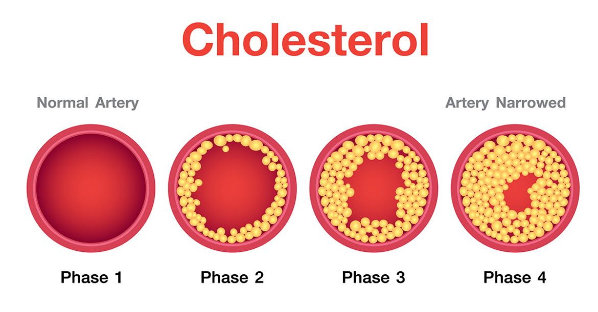 high cholesterol