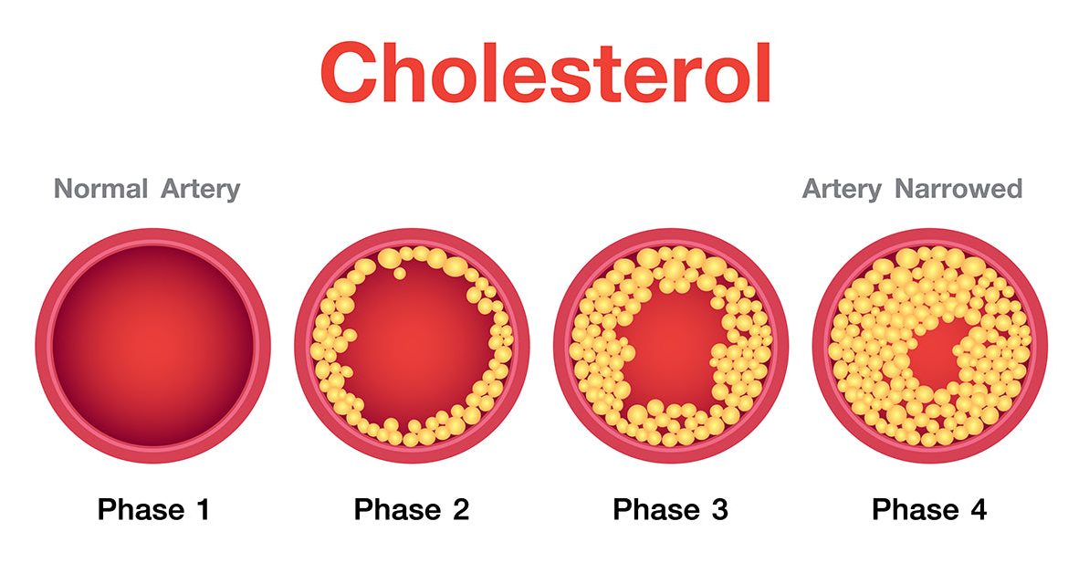 high cholesterol