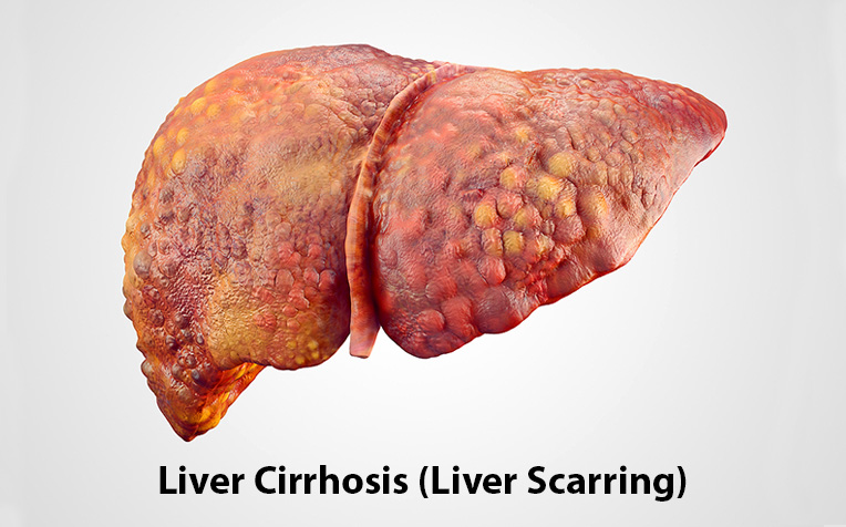 ​​​Liver Cirrhosis