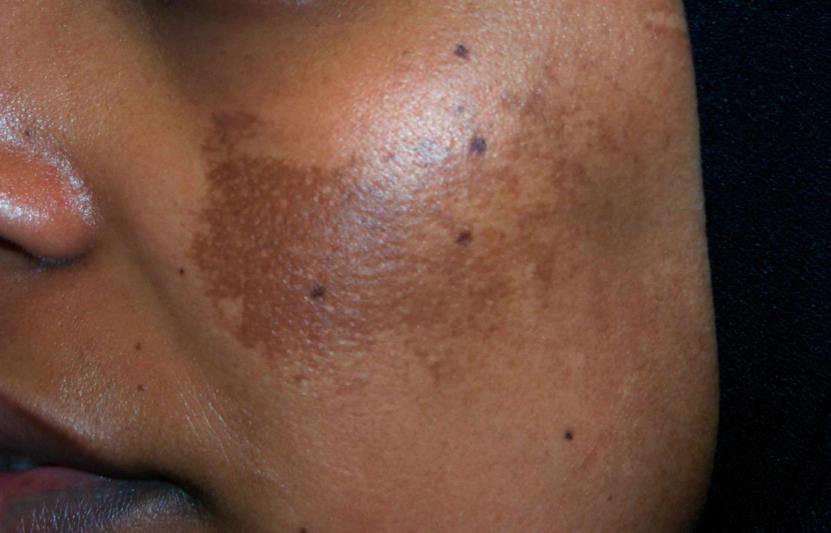 melasma