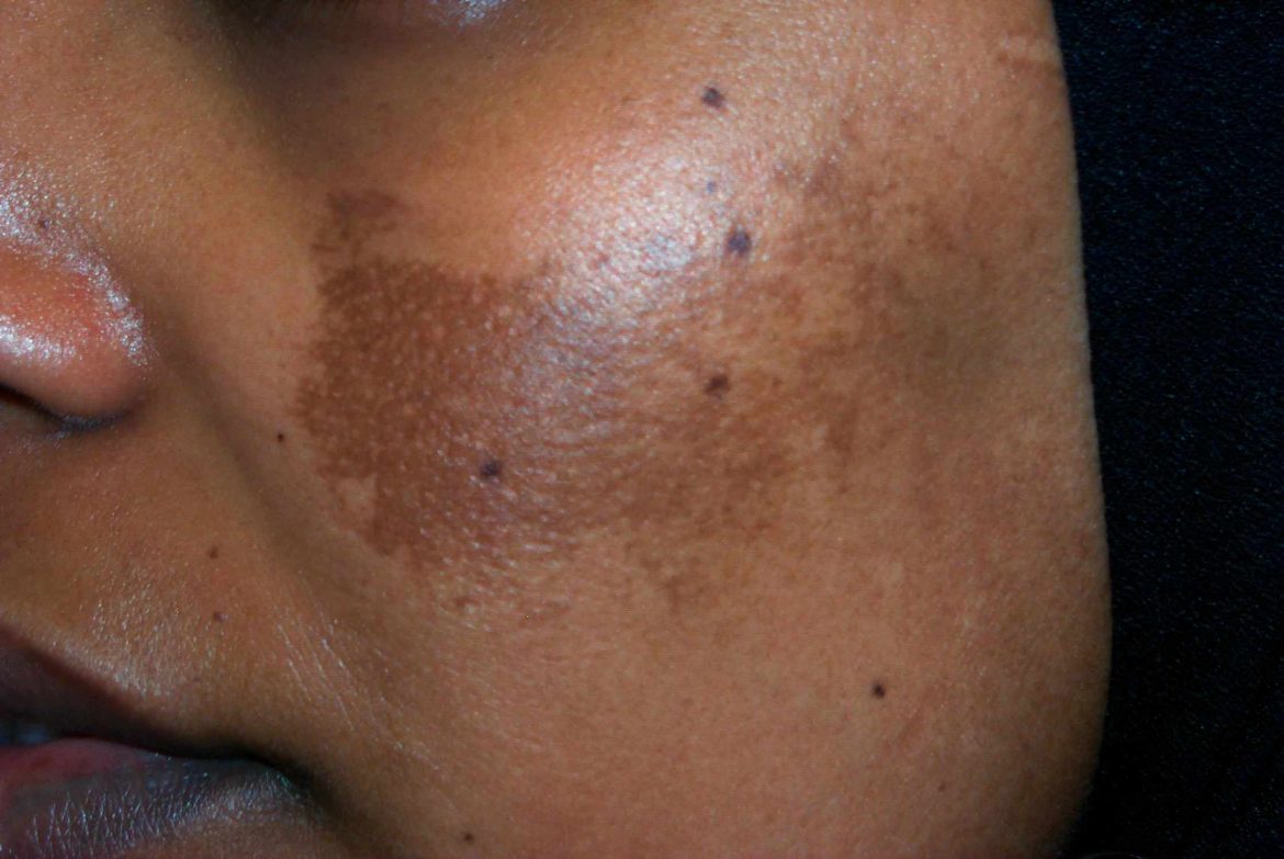 melasma