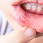 mouth-ulcers