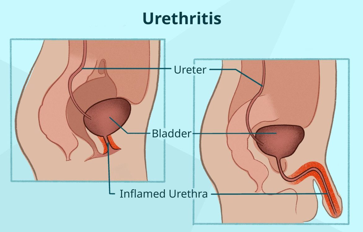 urethritis