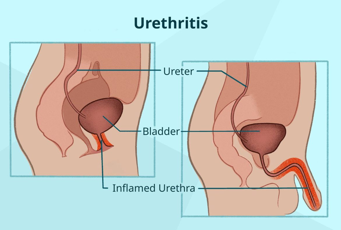 urethritis