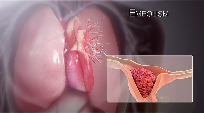 embolism