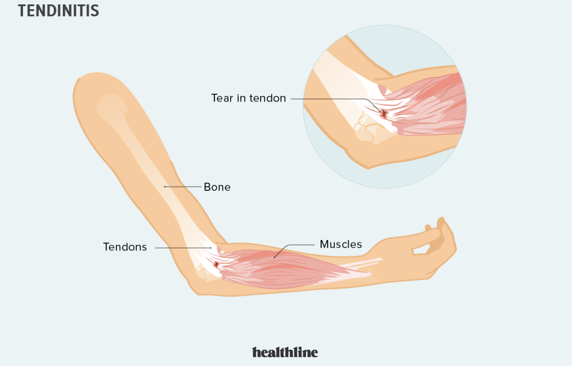 tendinitis