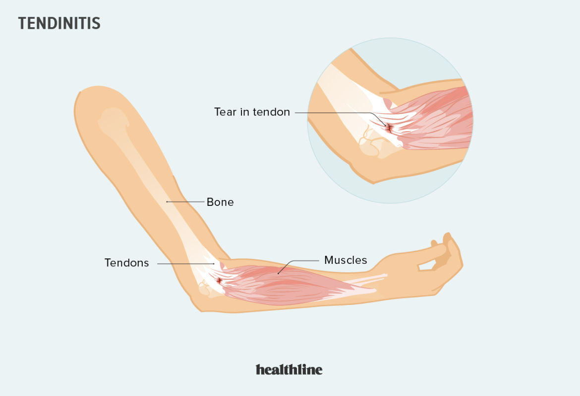 tendinitis